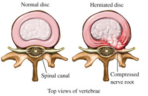 Bulging-Disc