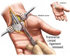 Surgery for carpal tunnel release
