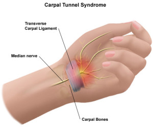 The carpal tunel