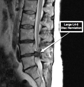 disc-herniation