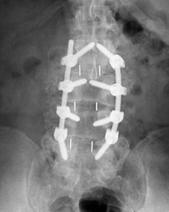 Lumbar fusion - anterior view